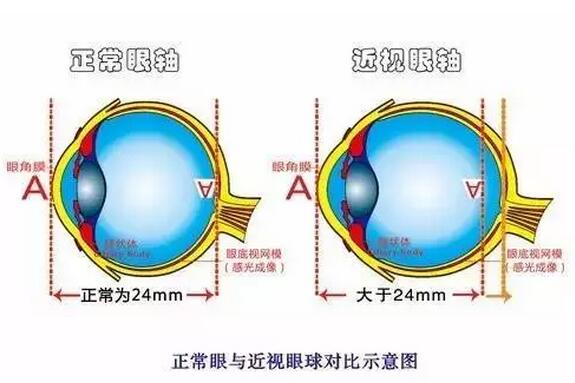 近視超過(guò)600度以上？這7條“錦囊”請(qǐng)收好！